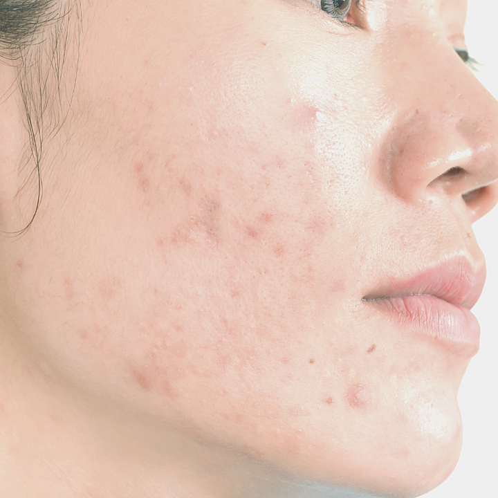 ACNE PRO COURSE